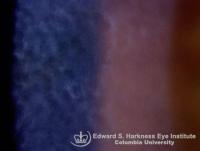 Thiel-Behnke Dystrophy